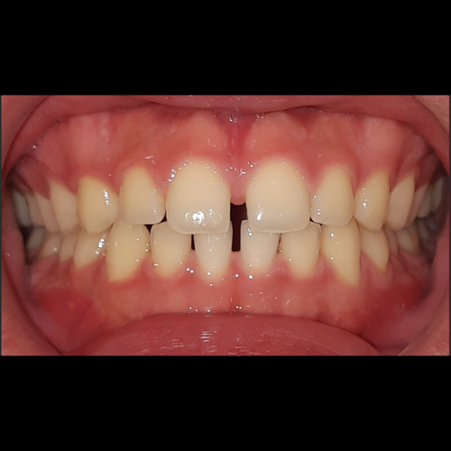 Before treatment