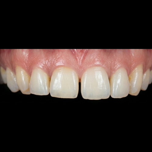 Before treatment